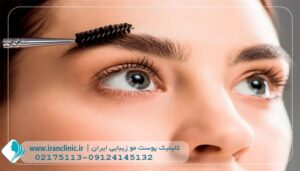 کاشت ابرو در سعادت آباد