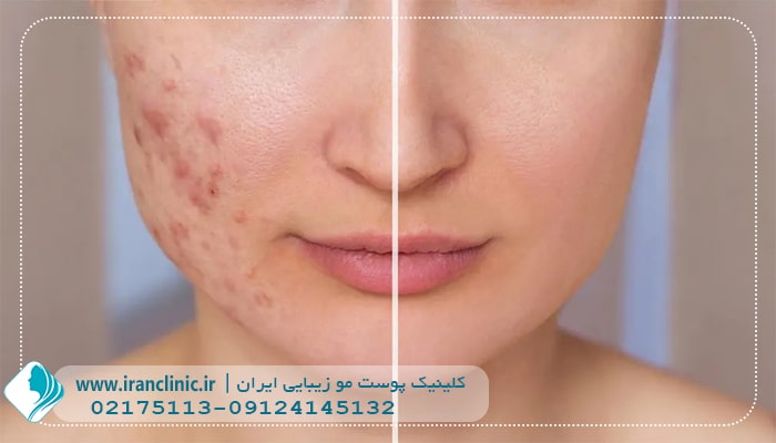لیزر جای جوش (2) لیزر جای جوش
