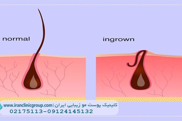 همه چیز درباره موی زیر پوستی