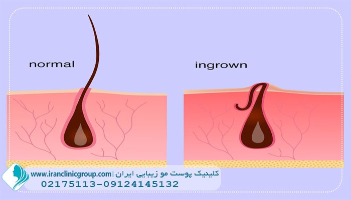 همه چیز درباره موی زیر پوستی