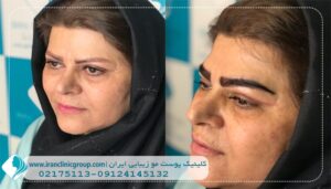بهترین کلینیک کاشت ابرو در تهران