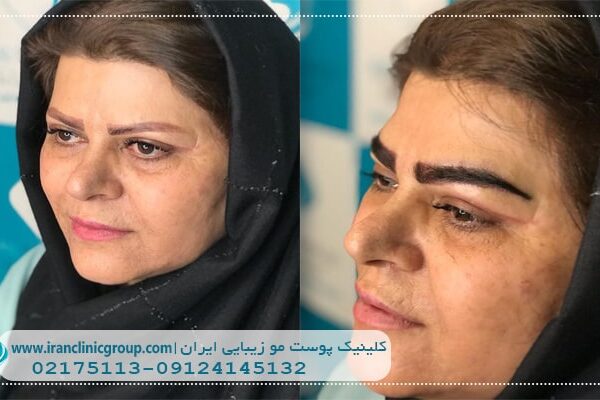 بهترین کلینیک کاشت ابرو در تهران