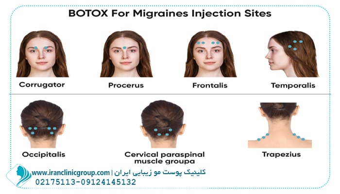 تزریق بوتاکس برای میگرن