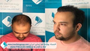 بهترین کلینیک کاشت مو تهران