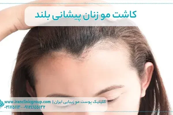 کاشت مو زنان پیشانی بلند