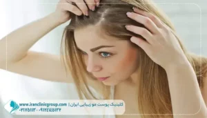 شرایط کاشت مو برای خانم‌ ها
