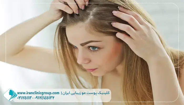 شرایط کاشت مو برای خانم‌ ها