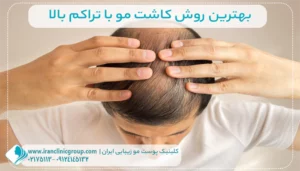کاشت مو با تراکم بالا