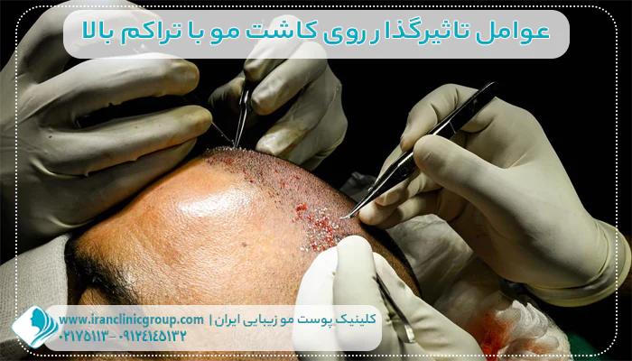 عوامل تاثیرگذار روی کاشت مو با تراکم بالا