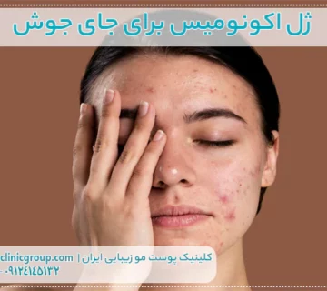 ژل اکنومیس برای جای جوش