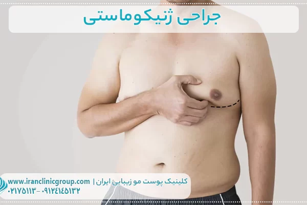 0 تا 100 جراحی ژنیکوماستی مزایا، عوارض، مراقبت های قبل و بعد 1 ژنیکوماستی1
