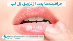 بعد از تزریق ژل لب