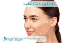 هایفو یا اندولیفت