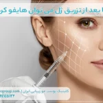 آیا بعد از تزریق ژل می توان هایفو کرد؟