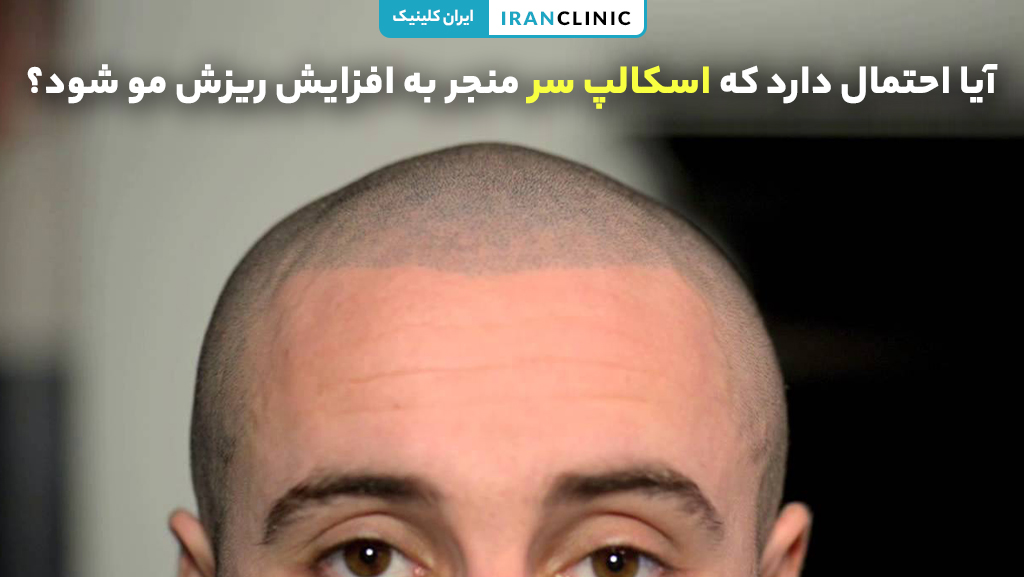 آیا اسکالپ سر باعث ریزش بیشتر مو می‌شود؟