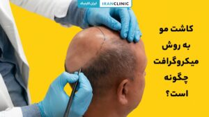 تصویر نحوه کاشت مو به روش میکروگرافت با جزئیات کامل