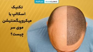 اسکالپ سر یا میکروپیگمنتیشن برای رفع طاسی و کم‌پشتی موها